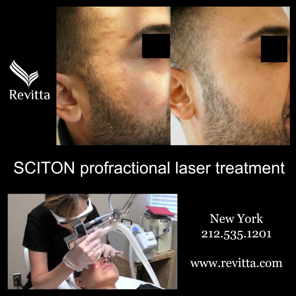 laser treatment acne scars. Fraxel laser treatment acne scars. New York laser treatment acne scars.