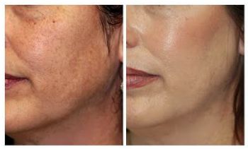 Neo-Peel is the latest light or supertficial chemical peel. Peel with no peeling visible. 