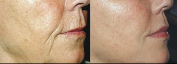 Radiesse New York | wrinkles treatment with Radiesse New York | dermal filler Radiesse New York, Manhattan and Brooklyn