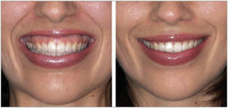 botox new york gummy smile treatment | Botox New York | Botox for gummy smile