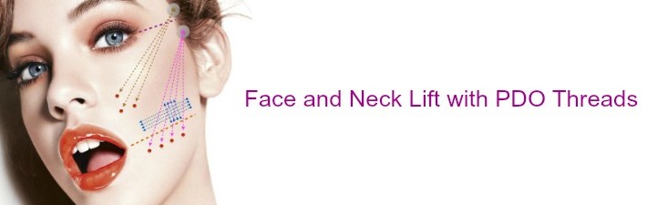 face and neck lift with pdo threads