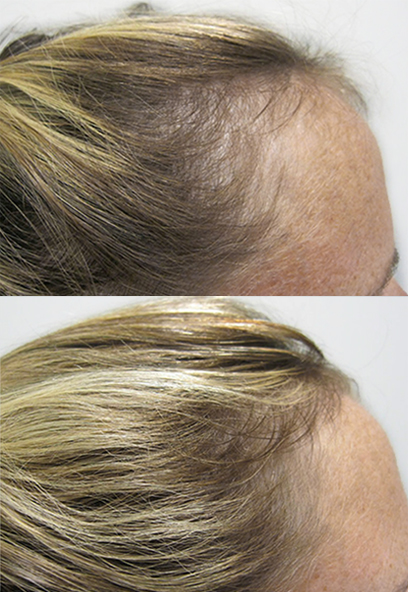 PRP Hair Los s Treatment Results