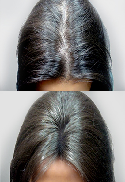 PRP Hair Los s Treatment Results